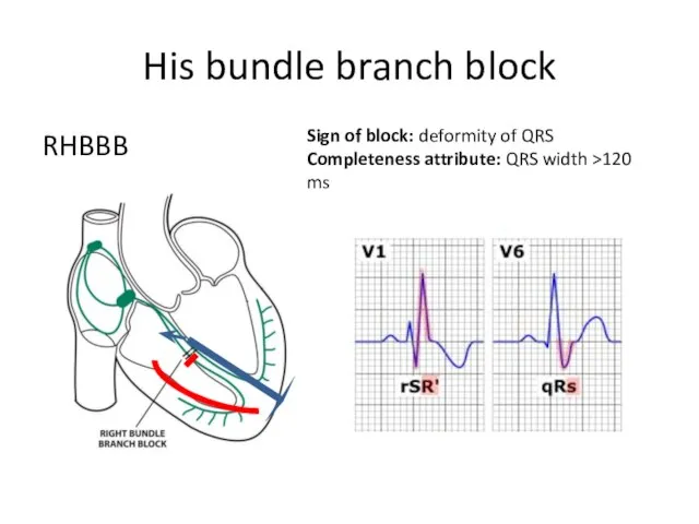 His bundle branch block RHBBB Sign of block: deformity of QRS Completeness