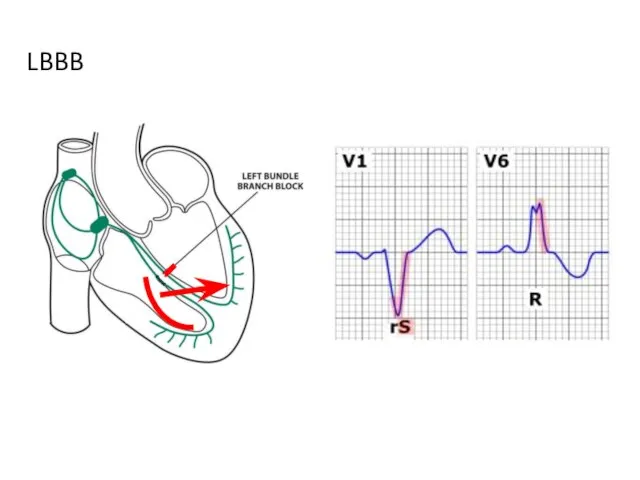 LBBB