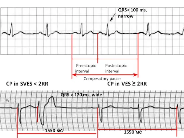 Compesatory pause Preectopic interval CP in SVES 1550 мс 1550 мс Postectopic