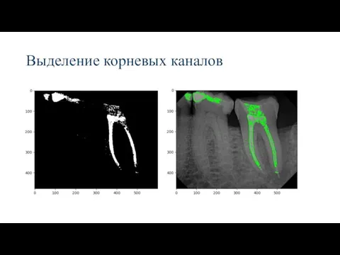 Выделение корневых каналов