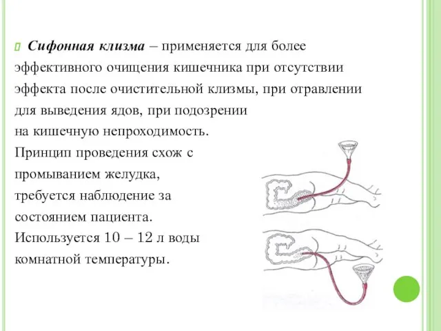 Сифонная клизма – применяется для более эффективного очищения кишечника при отсутствии эффекта