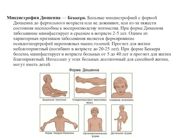 Миодистрофия Дюшенна — Беккера. Больные миодистрофией с формой Дюшенна до фертильного возраста