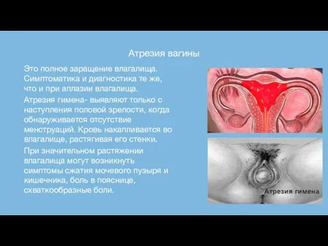 Атрезия вагины Это полное заращение влагалища. Симптоматика и диагностика те же, что