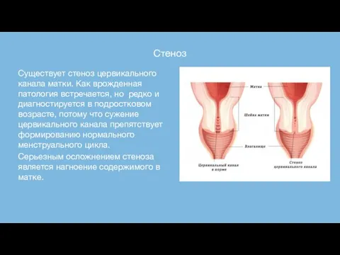 Стеноз Существует стеноз цервикального канала матки. Как врожденная патология встречается, но редко