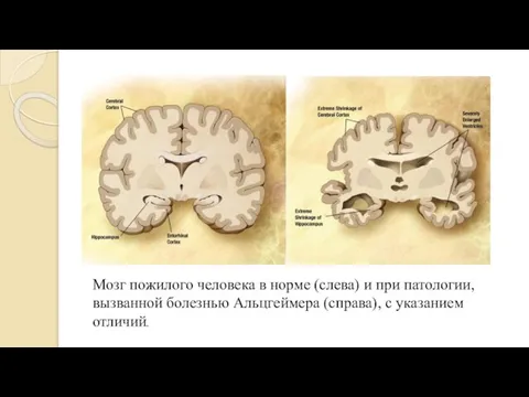 Мозг пожилого человека в норме (слева) и при патологии, вызванной болезнью Альцгеймера (справа), с указанием отличий.