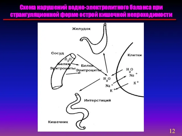 Схема нарушений водно-электролитного баланса при странгуляционной форме острой кишечной непроходимости