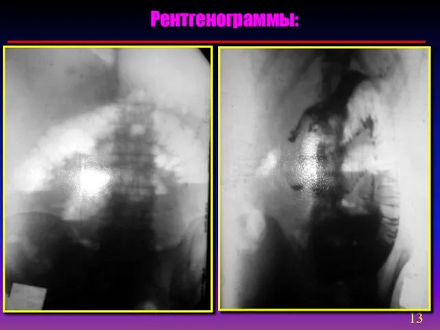 Рентгенограммы: