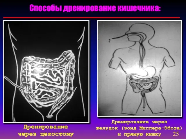 Способы дренирование кишечника: Дренирование через цекостому Дренирование через желудок (зонд Миллера-Эбота) и прямую кишку