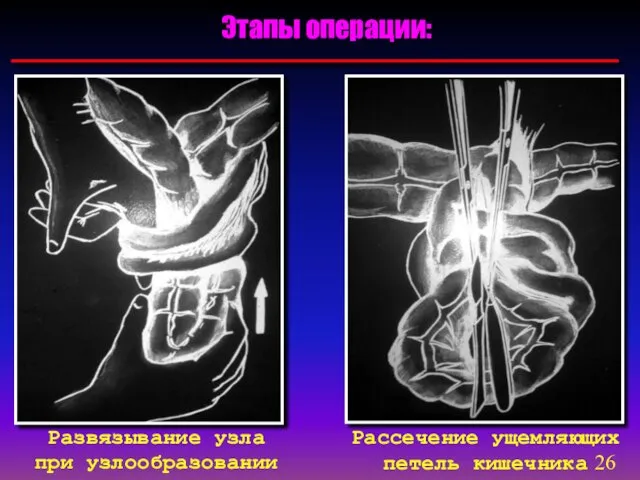 Этапы операции: Развязывание узла при узлообразовании Рассечение ущемляющих петель кишечника