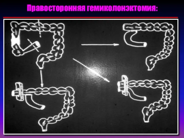 Правосторонняя гемиколонэктомия: