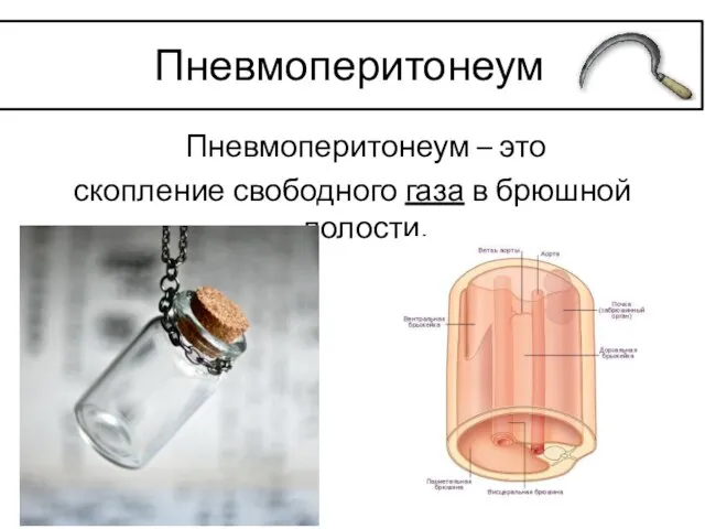 Пневмоперитонеум – это скопление свободного газа в брюшной полости. Пневмоперитонеум