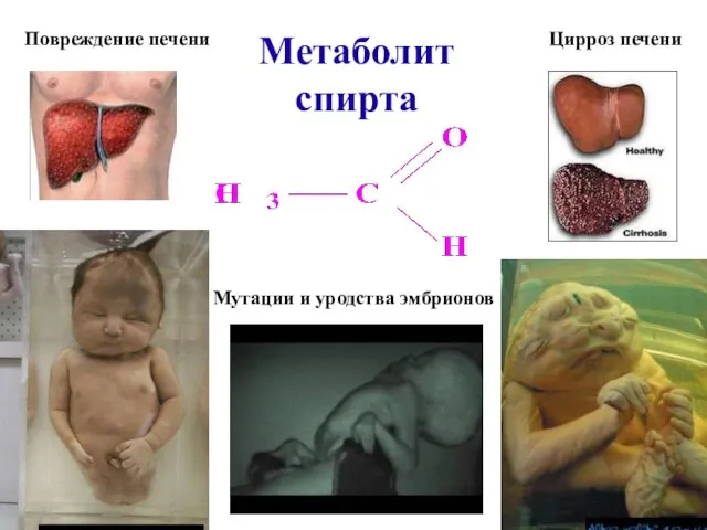 Метаболит спирта Повреждение печени Цирроз печени Мутации и уродства эмбрионов