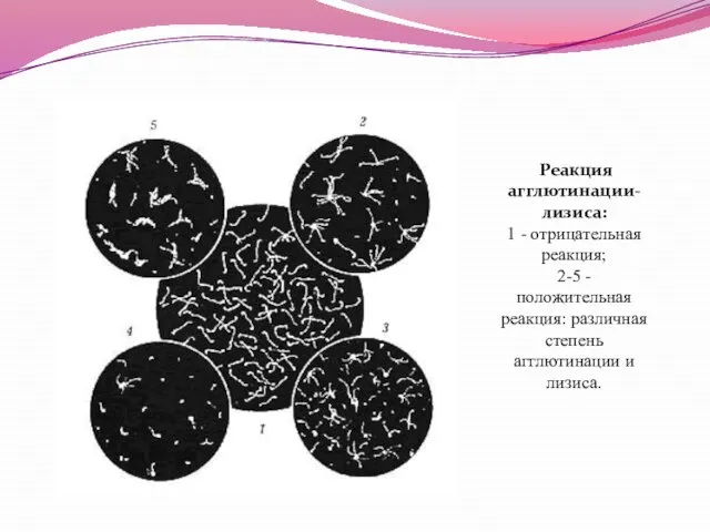 Реакция агглютинации-лизиса: 1 - отрицательная реакция; 2-5 - положительная реакция: различная степень агглютинации и лизиса.