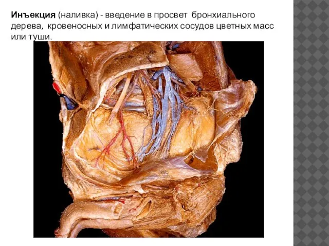 Инъекция (наливка) - введение в просвет бронхиального дерева, кровеносных и лимфатических сосудов цветных масс или туши.