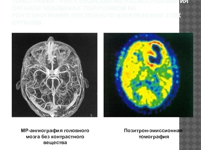 ТОМОГРАФИЯ - РЕНТГЕНОВСКИЙ МЕТОД ИССЛЕДОВАНИЯ ОРГАНОВ ЧЕЛОВЕКА С ПОЛУЧЕНИЕМ НА РЕНТГЕНОГРАММЕ ПОСЛОЙНОГО