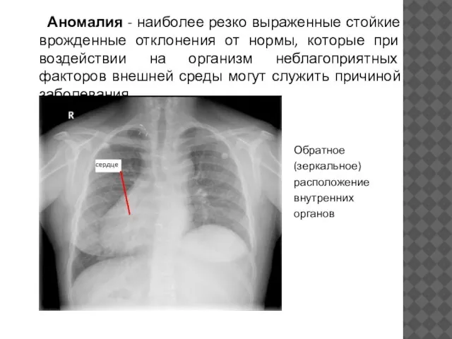 Аномалия - наиболее резко выраженные стойкие врожденные отклонения от нормы, которые при