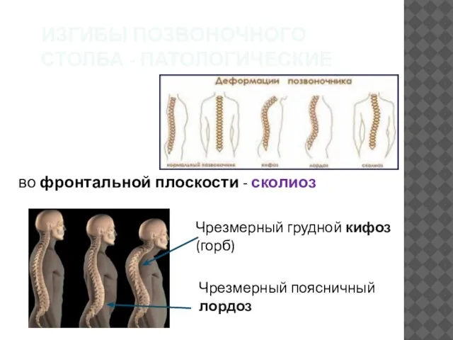 ИЗГИБЫ ПОЗВОНОЧНОГО СТОЛБА - ПАТОЛОГИЧЕСКИЕ во фронтальной плоскости - сколиоз Чрезмерный грудной