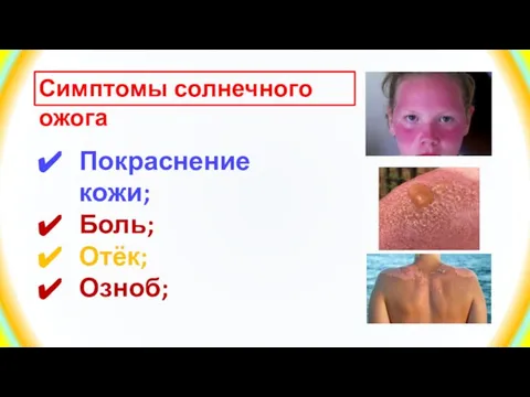 Симптомы солнечного ожога Покраснение кожи; Боль; Отёк; Озноб;