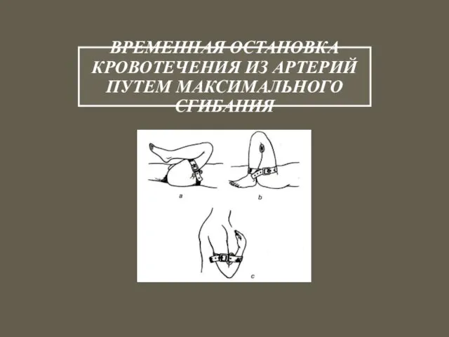 ВРЕМЕННАЯ ОСТАНОВКА КРОВОТЕЧЕНИЯ ИЗ АРТЕРИЙ ПУТЕМ МАКСИМАЛЬНОГО СГИБАНИЯ