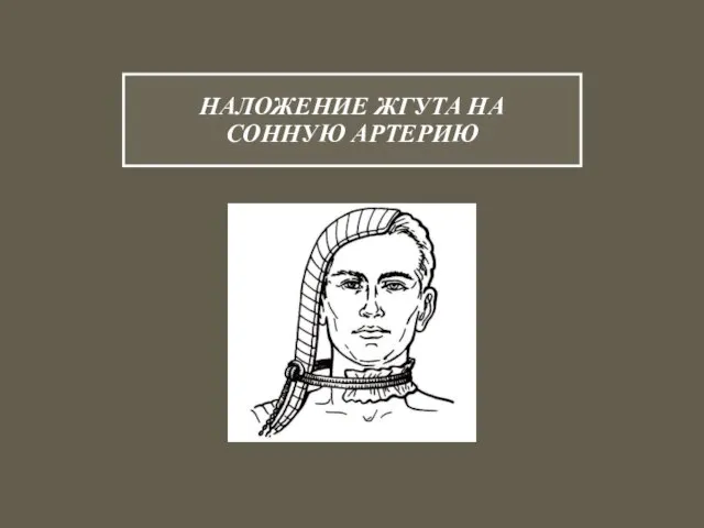 НАЛОЖЕНИЕ ЖГУТА НА СОННУЮ АРТЕРИЮ