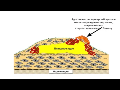 Адгезия и агрегация тромбоцитов в месте повреждения эндотелия, покрывающего атеросклеротическую бляшку