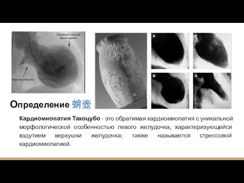 Определение Кардиомиопатия Такоцубо - это обратимая кардиомиопатия с уникальной морфологической особенностью левого