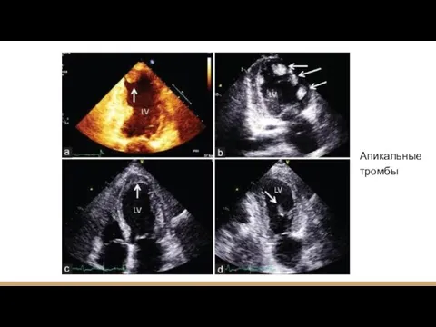 Апикальные тромбы