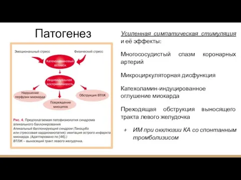 Патогенез Усиленная симпатическая стимуляция и её эффекты: Многососудистый спазм коронарных артерий Микроциркуляторная