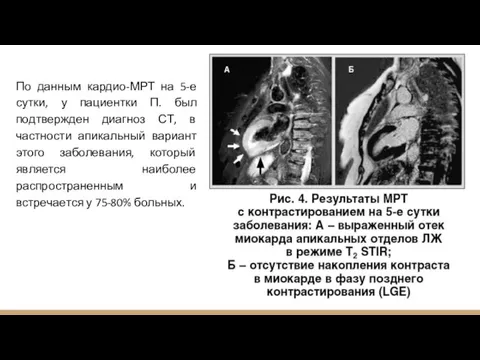 По данным кардио-МРТ на 5-е сутки, у пациентки П. был подтвержден диагноз