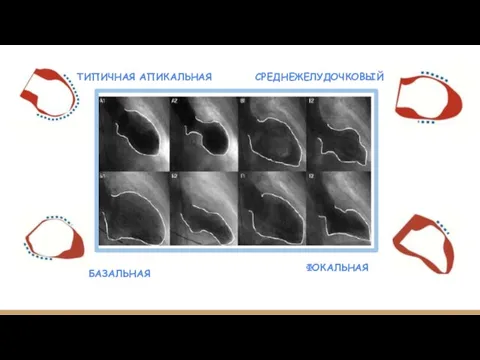 ТИПИЧНАЯ АПИКАЛЬНАЯ СРЕДНЕЖЕЛУДОЧКОВЫЙ БАЗАЛЬНАЯ ФОКАЛЬНАЯ