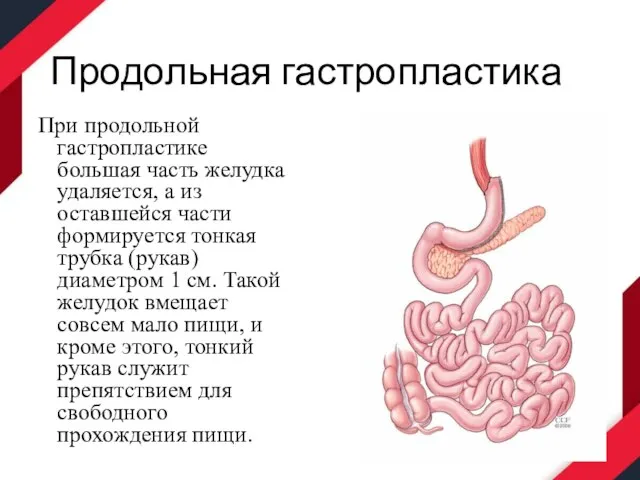 Продольная гастропластика При продольной гастропластике большая часть желудка удаляется, а из оставшейся