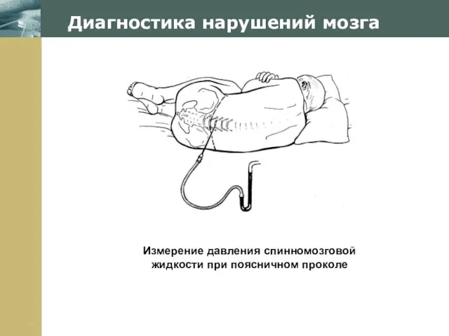 Company Logo Диагностика нарушений мозга Измерение давления спинномозговой жидкости при поясничном проколе