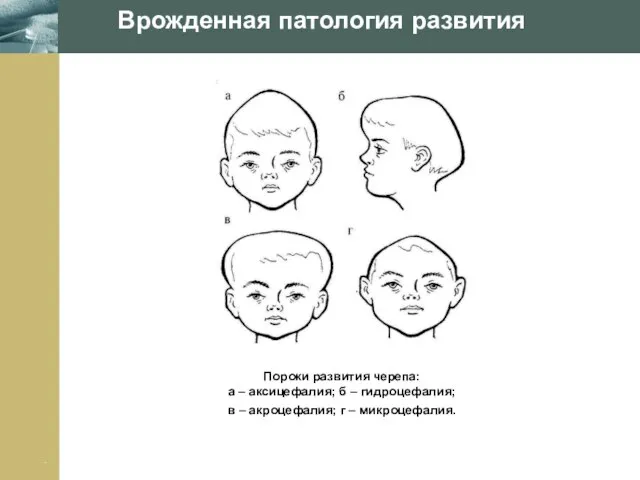 Company Logo Врожденная патология развития Пороки развития черепа: а – аксицефалия; б