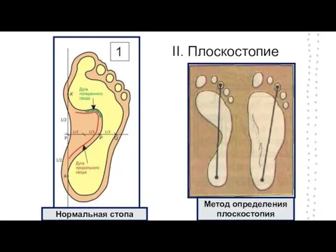 II. Плоскостопие Метод определения плоскостопия Нормальная стопа