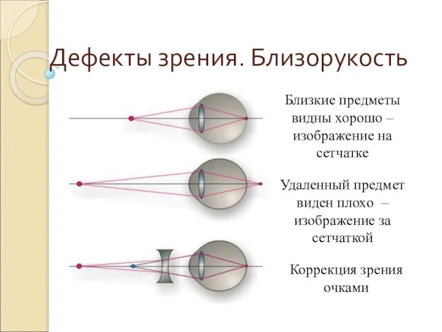 Дефекты зрения. Близорукость Близкие предметы видны хорошо – изображение на сетчатке Удаленный