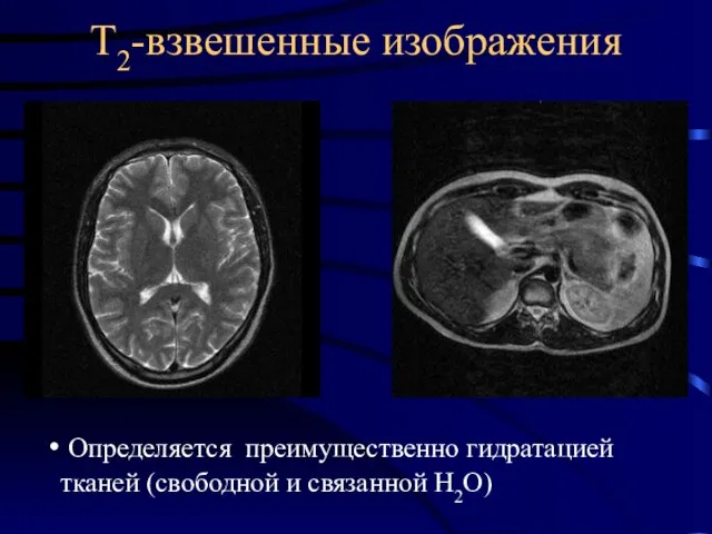 Т2-взвешенные изображения Определяется преимущественно гидратацией тканей (свободной и связанной H2O)