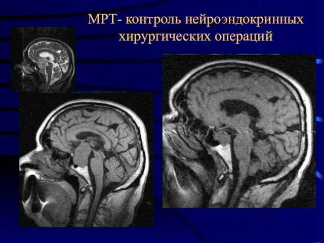 МРТ- контроль нейроэндокринных хирургических операций