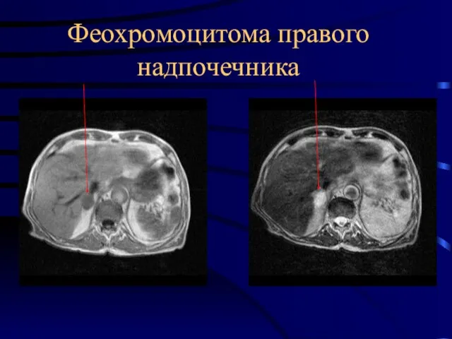 Феохромоцитома правого надпочечника