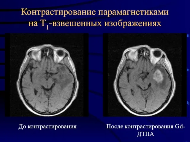 Контрастирование парамагнетиками на Т1-взвешенных изображениях До контрастирования После контрастирования Gd-ДТПА