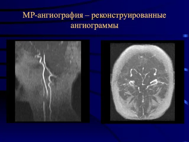 МР-ангиография – реконструированные ангиограммы