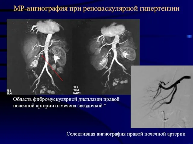 МР-ангиография при реноваскулярной гипертензии Область фибромускулярной дисплазии правой почечной артерии отмечена звездочкой