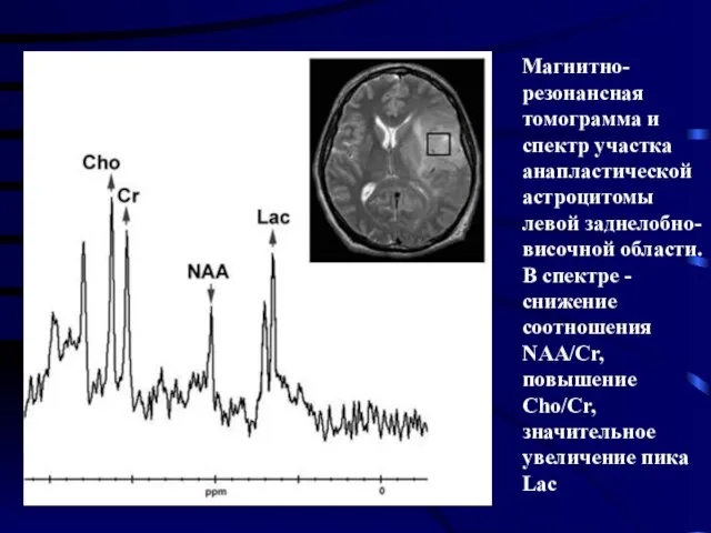 Магнитно-резонансная томограмма и спектр участка анапластической астроцитомы левой заднелобно-височной области. В спектре