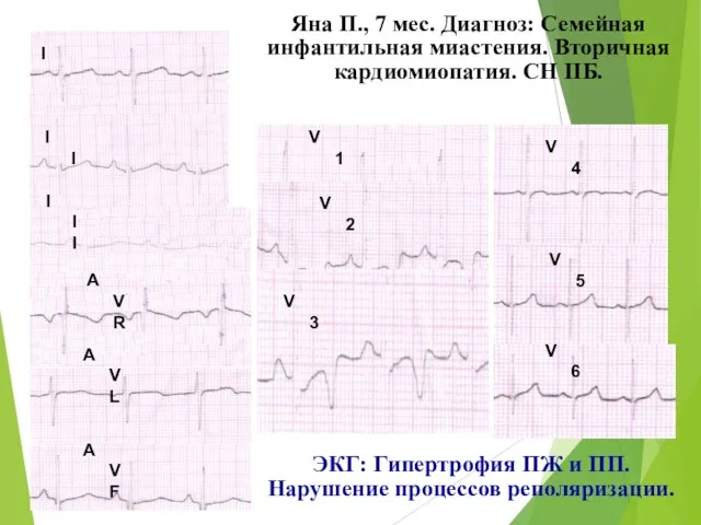 ЭКГ: Гипертрофия ПЖ и ПП. Нарушение процессов реполяризации. Яна П., 7 мес.