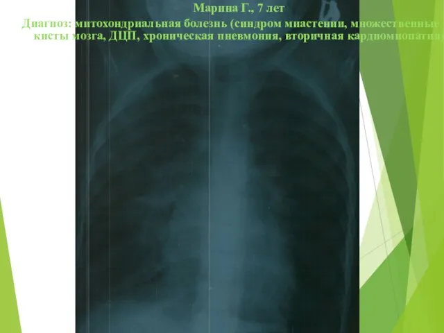 Марина Г., 7 лет Диагноз: митохондриальная болезнь (синдром миастении, множественные кисты мозга,