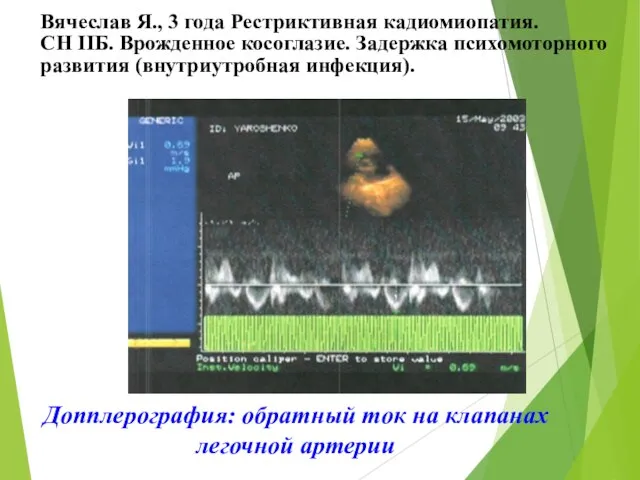 Допплерография: обратный ток на клапанах легочной артерии Вячеслав Я., 3 года Рестриктивная