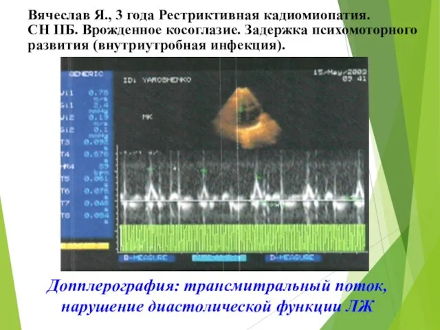 Допплерография: трансмитральный поток, нарушение диастолической функции ЛЖ Вячеслав Я., 3 года Рестриктивная