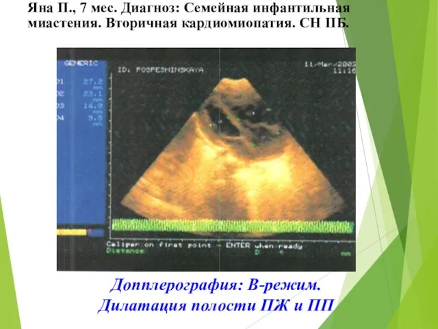 Допплерография: В-режим. Дилатация полости ПЖ и ПП Яна П., 7 мес. Диагноз: