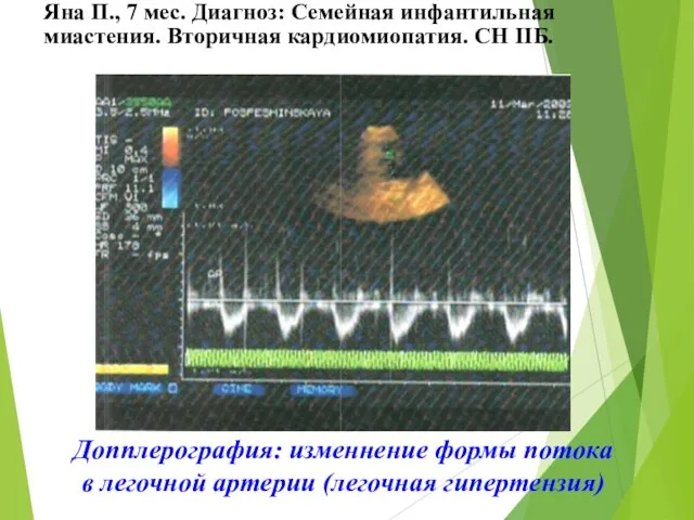 Допплерография: изменнение формы потока в легочной артерии (легочная гипертензия) Яна П., 7