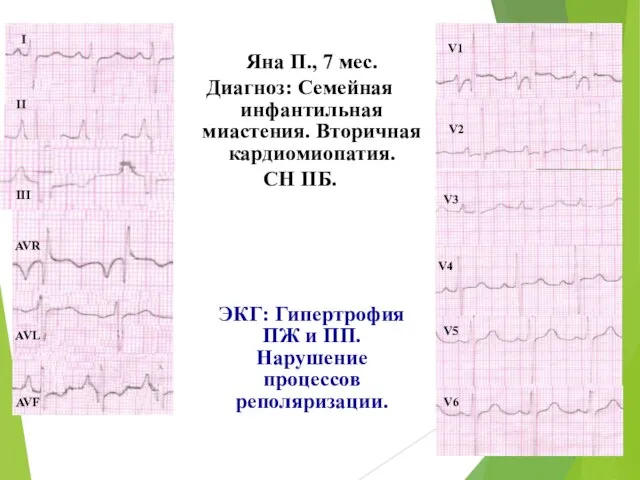 Яна П., 7 мес. Диагноз: Семейная инфантильная миастения. Вторичная кардиомиопатия. СН ІІБ.