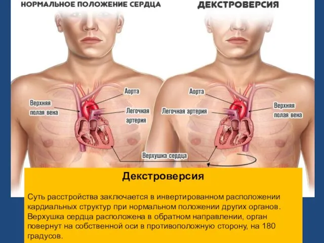 Декстроверсия Суть расстройства заключается в инвертированном расположении кардиальных структур при нормальном положении